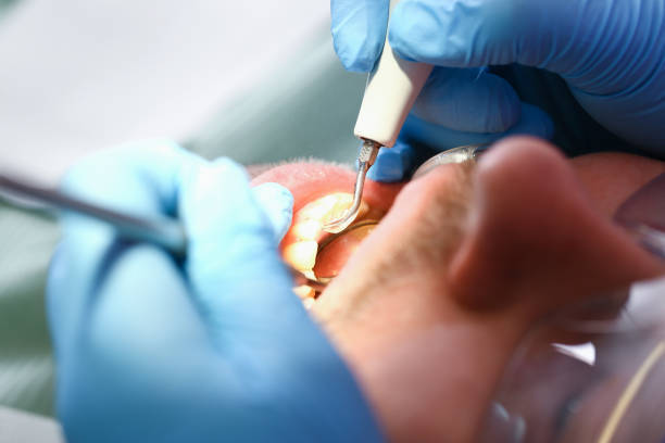 Best Chipped Tooth Repair Near Me  in Earlington, KY